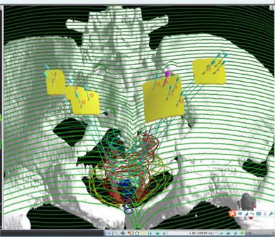 A new technique for trans-perirectal iodine-125 seed implantation in prostatic cancer guided by CT and 3D printed template: Two case reports